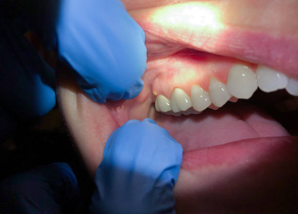 Best Tooth Infection Emergency Dentist  in Kentwood, MI